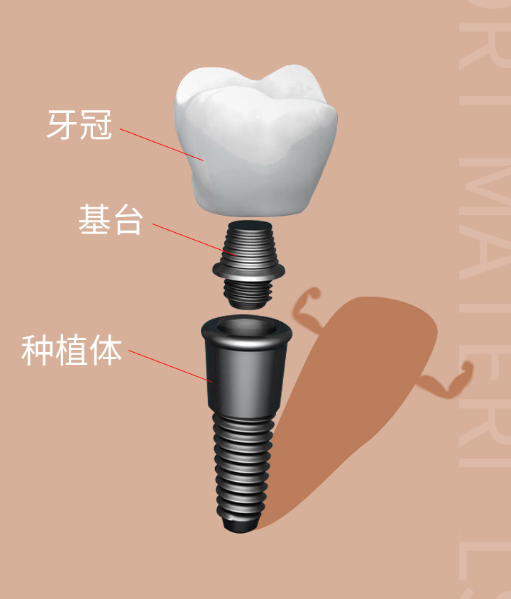 一顆種植牙的構成